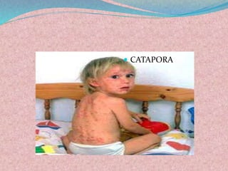  CATAPORA 
 