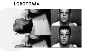 LOBOTOMIA
 