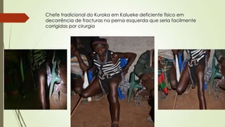 Chefe tradicional do Kuroka em Kalueke deficiente físico em
decorrência de fracturas na perna esquerda que seria facilmente
corrigidas por cirurgia
 