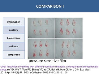 07/06/2016 1818
• Bibliographie
COMPARISON I
introduction
anatomy
biomechanic
arthrosis
comparison
pressure sensitive film
Ulnar impaction syndrome with different operative methods: a comparative biomechanical
study.Yu YD, Wu T, Tian FT, Shang YT, Yu XF, Bai YB, Han CL.Int J Clin Exp Med.
2015 Apr 15;8(4):5715-22. eCollection 2015.PMID: 26131156
 