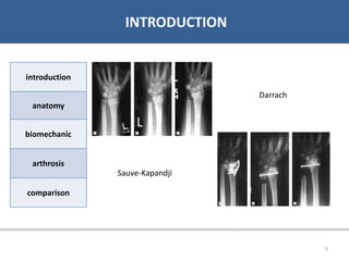 07/06/2016 55
• Bibliographie
INTRODUCTION
introduction
anatomy
biomechanic
arthrosis
comparison
Darrach
Sauve-Kapandji
 
