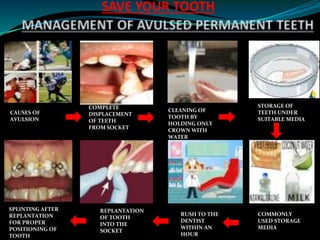 COMPLETE
DISPLACEMENT
OF TEETH
FROM SOCKET
CAUSES OF
AVULSION
CLEANING OF
TOOTH BY
HOLDING ONLY
CROWN WITH
WATER
STORAGE OF
TEETH UNDER
SUITABLE MEDIA
COMMONLY
USED STORAGE
MEDIA
RUSH TO THE
DENTIST
WITHIN AN
HOUR
REPLANTATION
OF TOOTH
INTO THE
SOCKET
SPLINTING AFTER
REPLANTATION
FOR PROPER
POSITIONING OF
TOOTH
SAVE YOUR TOOTH
 