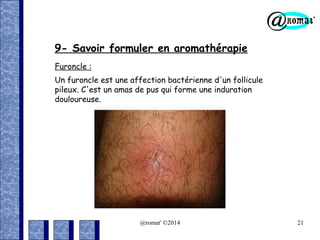 9- Savoir formuler en aromathérapie
Furoncle :
Un furoncle est une affection bactérienne d'un follicule
pileux. C'est un amas de pus qui forme une induration
douloureuse.

@romat' ©2014

21

 