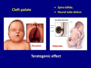 Cleft palate
• Spina bifida.
• Neural tube defect.
Valproate
Phenytoin
Teratogenic effect
 
