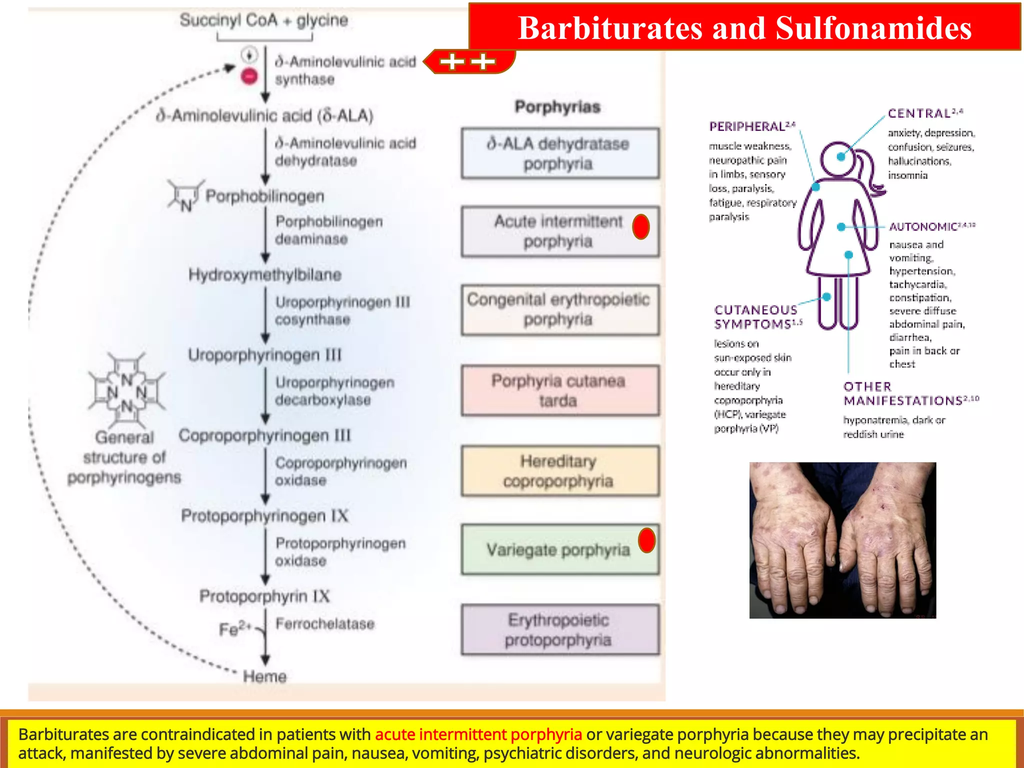 Barbiturates and Sulfonamides
Barbiturates are contraindicated in patients with acute intermittent porphyria or variegate porphyria because they may precipitate an
attack, manifested by severe abdominal pain, nausea, vomiting, psychiatric disorders, and neurologic abnormalities.
 