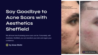 Say Goodbye to
Acne Scars with
Aesthetics
Sheffield
We all know how frustrating acne scars can be. Fortunately, with
Aesthetics Sheffield, you can transform your skin and regain your
confidence.
by kiran Bisht
KB
 