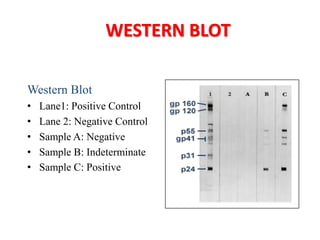 WESTERN BLOT
Western Blot
• Lane1: Positive Control
• Lane 2: Negative Control
• Sample A: Negative
• Sample B: Indeterminate
• Sample C: Positive
 