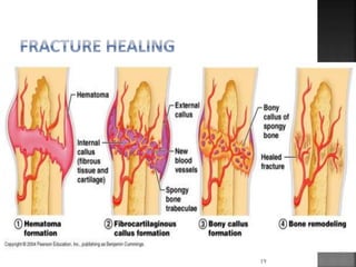 Fracture | PPTX