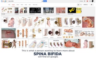 This is what a person wanting to learn more about
will find on google.
SPINA BIFIDA
 
