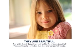 This birth defect doesn’t prevent a child from being beautiful.
They continue to remind us that they are wonderfully made.
THEY ARE BEAUTIFUL.
 