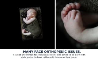 It is not uncommon for individuals with spina bifida to be born with
club feet or to have orthopedic issues as they grow.
MANY FACE ORTHOPEDIC ISSUES.
 