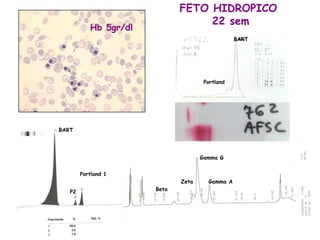 Hematología
FETO HIDROPICO
22 sem
Hb 5gr/dl
BART
Portland
BART
Portland 1
P2 Beta
Zeta
Gamma G
Gamma A
 
