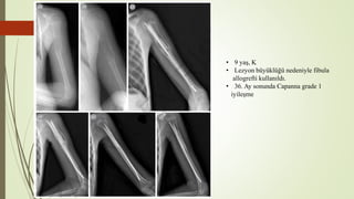 • 9 yaş, K
• Lezyon büyüklüğü nedeniyle fibula
allogrefti kullanıldı.
• 36. Ay sonunda Capanna grade 1
iyileşme
 