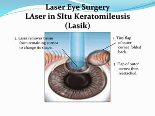 1. Tiny flap
of outer
cornea folded
back.
2. Laser removes tissue
from remaining cornea
to change its shape.
3. Flap of outer
cornea then
reattached.
Laser Eye Surgery
LAser in SItu Keratomileusis
(Lasik)
 