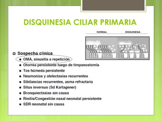 DISQUINESIA CILIAR PRIMARIA
 