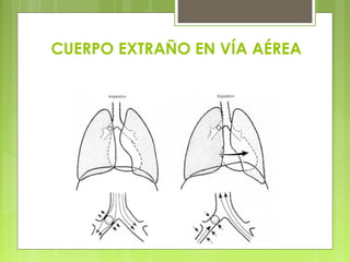 CUERPO EXTRAÑO EN VÍA AÉREA
 