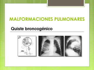 MALFORMACIONES PULMONARES
 