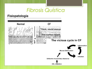 Fibrosis Quística
 