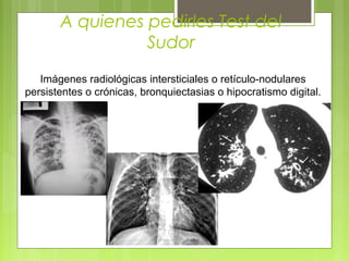 A quienes pedirles Test del
Sudor
Imágenes radiológicas intersticiales o retículo-nodulares
persistentes o crónicas, bronquiectasias o hipocratismo digital.
 