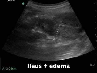 Point of care Intestinal Ultrasound: Lauren Westafer
