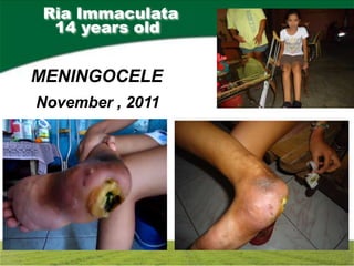 Ria Immaculata
  14 years old


MENINGOCELE
November , 2011
 
