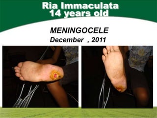 Ria Immaculata
 14 years old
 MENINGOCELE
 December , 2011
 