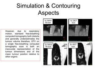 Simulation & Contouring
Aspects
However, due to respiratory
motion, standard free-breathing
computed tomography both distorts
and generally underestimates the
tumour volume therefore, GTV on
a single free-breathing computed
tomography scan is both an
inaccurate representation of the
tumour dimensions and of the
mean tumour position relative to
other organs
 