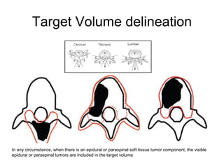 Target Volume delineation
In any circumstance, when there is an epidural or paraspinal soft tissue tumor component, the visible
epidural or paraspinal tumors are included in the target volume
 