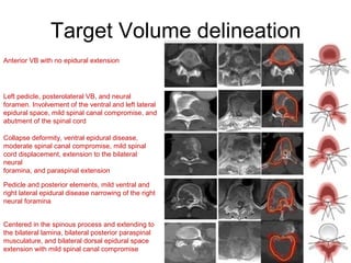 Target Volume delineation
Anterior VB with no epidural extension
Left pedicle, posterolateral VB, and neural
foramen. Involvement of the ventral and left lateral
epidural space, mild spinal canal compromise, and
abutment of the spinal cord
Collapse deformity, ventral epidural disease,
moderate spinal canal compromise, mild spinal
cord displacement, extension to the bilateral
neural
foramina, and paraspinal extension
Pedicle and posterior elements, mild ventral and
right lateral epidural disease narrowing of the right
neural foramina
Centered in the spinous process and extending to
the bilateral lamina, bilateral posterior paraspinal
musculature, and bilateral dorsal epidural space
extension with mild spinal canal compromise
 