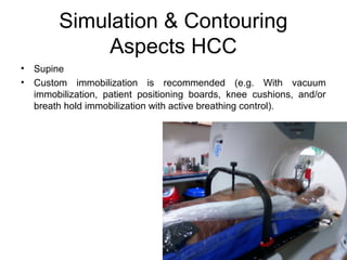 Simulation & Contouring
Aspects HCC
• Supine
• Custom immobilization is recommended (e.g. With vacuum
immobilization, patient positioning boards, knee cushions, and/or
breath hold immobilization with active breathing control).
 