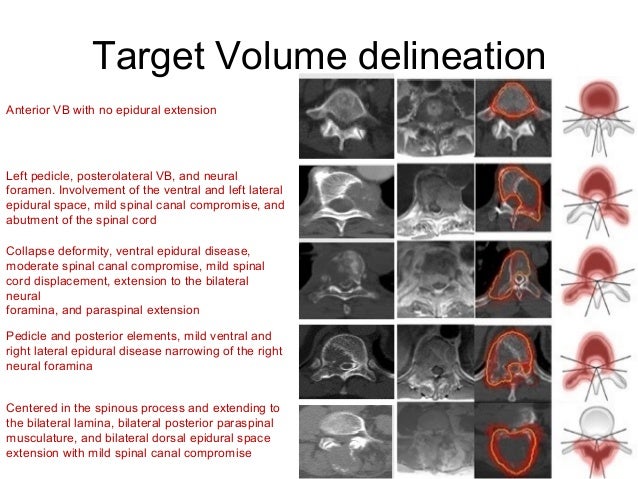 SBRT Contouring Guidelines