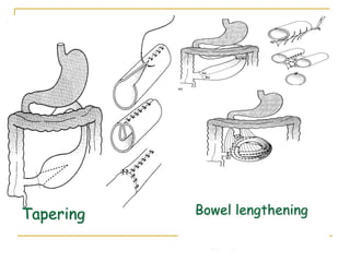 Tapering Bowel lengthening
 