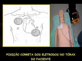 POSIÇÃO CORRETA DOS ELETRODOS NO TÓRAX
DO PACIENTE

 