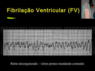 Fibrilação Ventricular (FV)

Ritmo desorganizado – vários pontos mandando comando

 