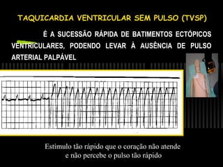 • TAQUICARDIA VENTRICULAR SEM PULSO (TVSP)
- É A SUCESSÃO RÁPIDA DE BATIMENTOS ECTÓPICOS
VENTRICULARES, PODENDO LEVAR À AUSÊNCIA DE PULSO
ARTERIAL PALPÁVEL

Estímulo tão rápido que o coração não atende
e não percebe o pulso tão rápido

 