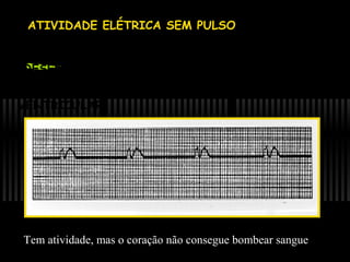 • ATIVIDADE ELÉTRICA SEM PULSO
- AUSÊNCIA DE PULSO DETECTÁVEL NA
PRESENÇA

DE

ALGUMA

EXCETO

FIBRILAÇÃO

ATIVIDADE
OU

ELÉTRICA,

TAQUICARDIA

VENTRICULAR

Tem atividade, mas o coração não consegue bombear sangue

 
