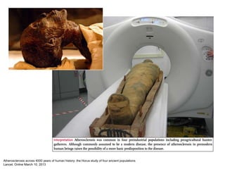 Atherosclerosis across 4000 years of human history: the Horus study of four ancient populations
Lancet. Online March 10, 2...