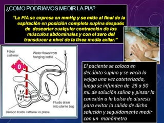 El paciente se coloca en
decúbito supino y se vacía la
vejiga una vez cateterizada,
luego se infunden de 25 a 50
mL de solución salina y pinzar la
conexión a la bolsa de diuresis
para evitar la salida de dicha
solución y seguidamente medir
con un manómetro
 
