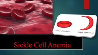 Sickle Cell Anemia
 