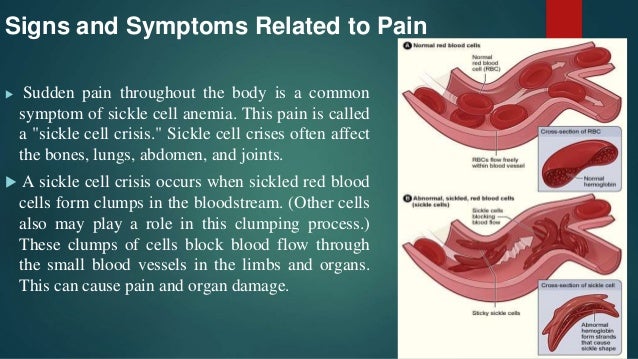 Sickle Cell Anemia and glucose-6-phosphate dehydrogenase