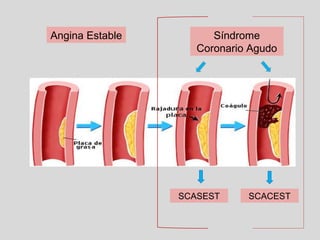 s-ndrome-coronario-agudo-en-atenci-n-primaria-osakidetza-ppt