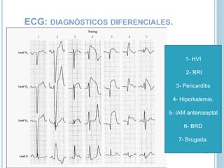 ECG: DIAGNÓSTICOS DIFERENCIALES.
1- HVI
2- BRI
3- Pericarditis
4- Hiperkalemia.
5- IAM anteroseptal
6- BRD
7- Brugada.
 