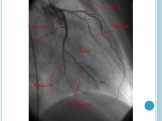 Art Cx
Porción AV
Art marginal
Tronco izq
1° septal
1° diagonal
Art DA
 