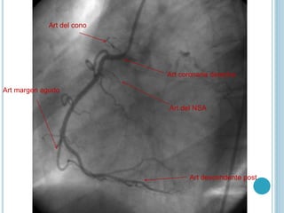 Art coronaria derecha
Art descendente post
Art margen agudo
Art del cono
Art del NSA
 