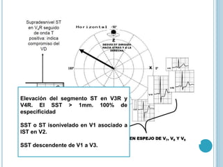 Elevación del segmento ST en V3R y
V4R. El SST > 1mm. 100% de
especificidad
SST o ST isonivelado en V1 asociado a
IST en V2.
SST descendente de V1 a V3.
 