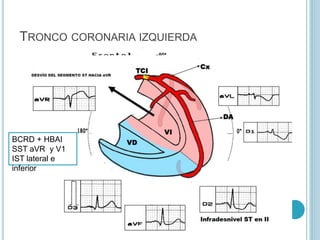 TRONCO CORONARIA IZQUIERDA
BCRD + HBAI
SST aVR y V1
IST lateral e
inferior
 