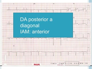 DA posterior a
diagonal.
IAM: anterior
 