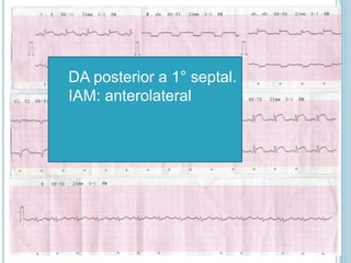 DA posterior a 1° septal.
IAM: anterolateral
 