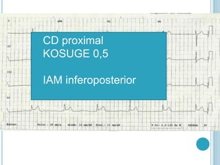 CD proximal
KOSUGE 0,5
IAM inferoposterior
 