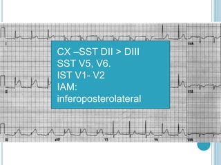 CX –SST DII > DIII
SST V5, V6.
IST V1- V2
IAM:
inferoposterolateral
 